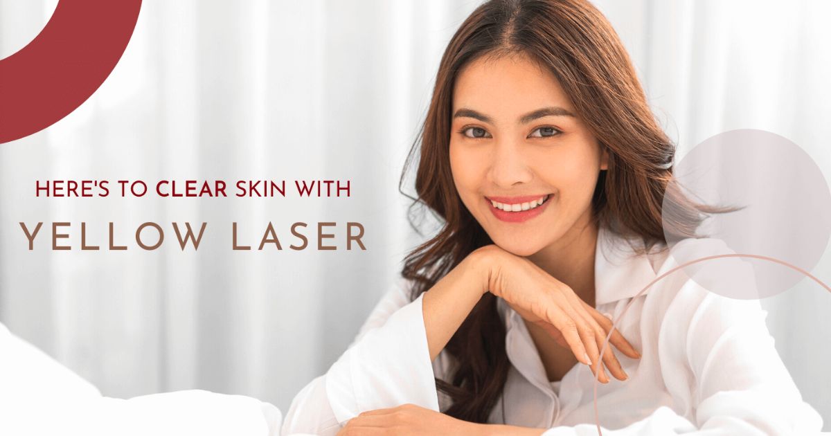 Dual Yellow Laser | Chelsea Clinic
