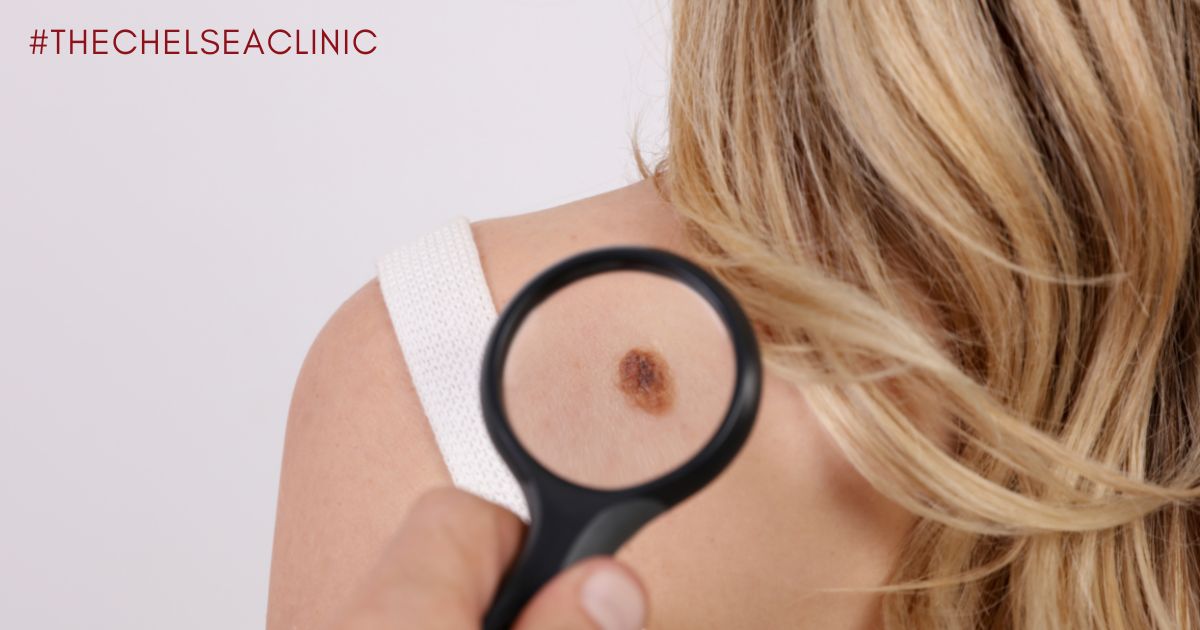 Mole Removal | Chelsea Clinic