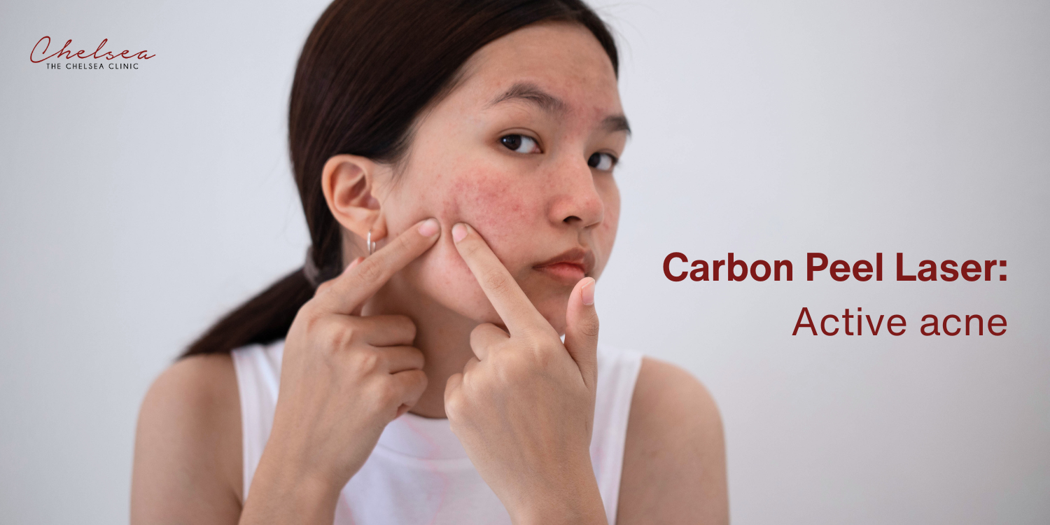 carbon peel laser, the chelsea clinic