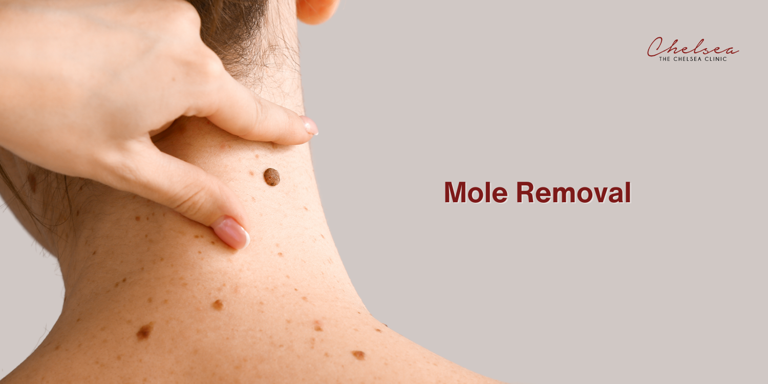 mole removal, the chelsea clinic