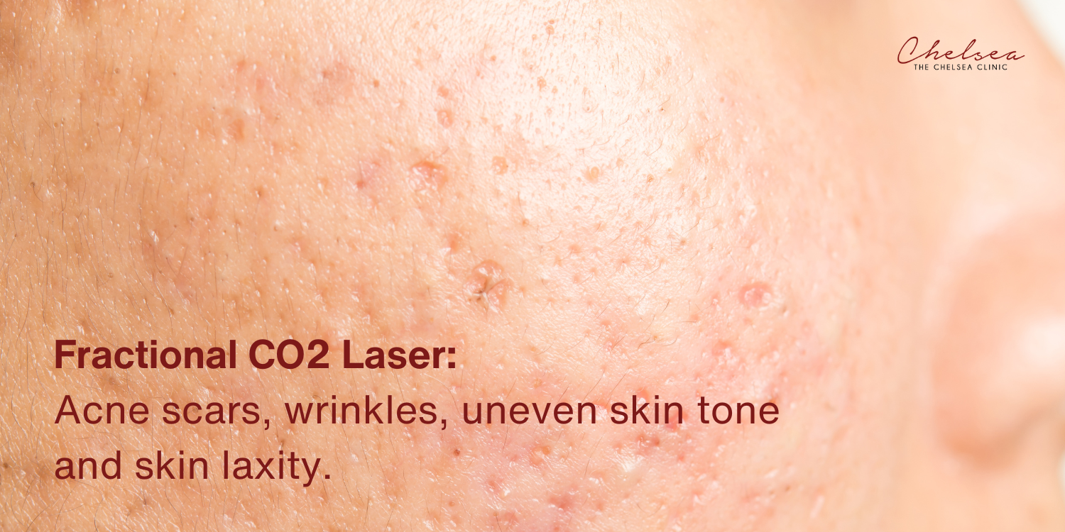 acne scar, the chelsea clinic